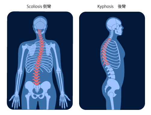 Scoliosis 側彎　Kyphosis 後彎