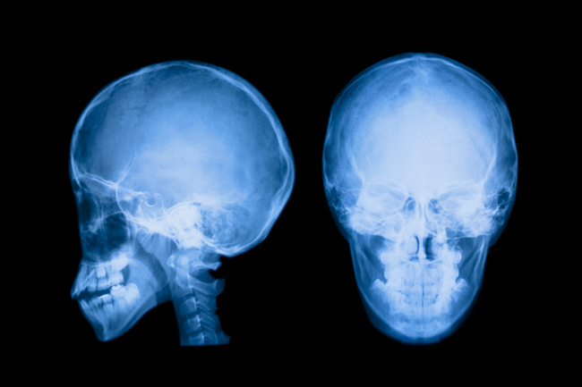 慢性硬膜下血腫の診断